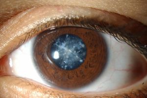Ce este cataracta? Tipuri de cataractă, simptome, tratament