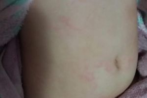 FOTO O fetiţă de trei ani s-a ales cu bube după ce a mâncat chipsuri expirate. „Am sunat de cinci ori la Protecţia Consumatorului şi nu ne-a răspuns nimeni”
