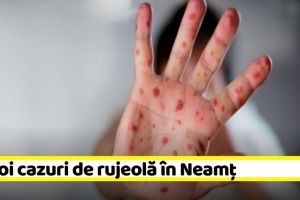 34 noi cazuri de rujeolă în Neamţ, în această săptămână