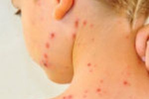În plină pandemie de coronavirus, rujeola face şi ea o mulţime de victime!