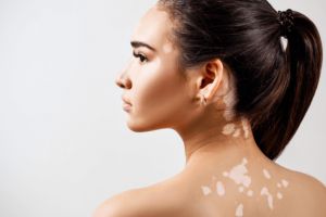 Vitiligo – Cum se manifestă, complicaţii, factori de risc, tratament