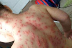Raport îngrijorător: Satu Mare, pe primul loc la cazurile de rujeolă. 20.000 în România