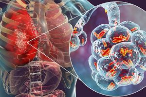 Pneumonia – Totul despre penumonie, cazue, simptome, tratament