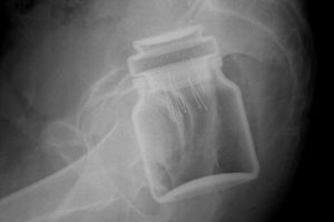 Un bărbat din Botoşani a ajuns la Urgenţe cu un borcan în anus: 