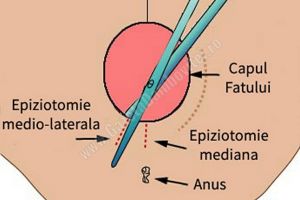 O GRAVIDĂ INFORMATĂ, UN COPIL SĂNĂTOS: Epiziotomia, o intervenţie controversată