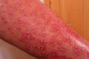 Erupţie cutanată. Simptome