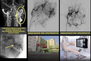 Operaţie în premieră. Fată de 11 ani salvată de medicii timişoreni