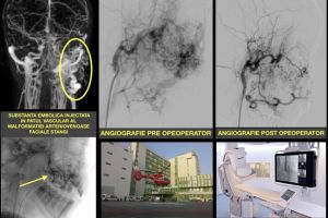 Premiera la Spitalul Judetean Timisoara. O fetita a fost operata de o malformatie de mari dimensiuni