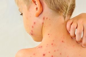 Un nou caz de rujeolă în Ialomiţa