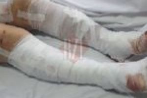 NEWS ALERT. Femeie în stare critică după ce a fost muşcată de câini! A pierdut câţiva litri de sânge!