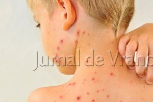 Șapte cazuri de rujeolă confirmate într-o săptămână!