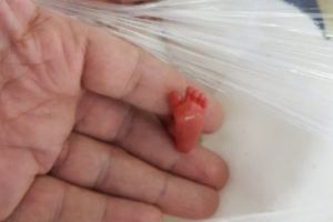 Este singurul bebeluş care a supravieţuit deşi a fost născut prematur la 12 săptpmâniImaginile sunt incredibile