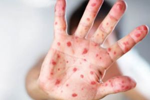 Alte 20 de cazuri de rujeolă, confirmate în Prahova