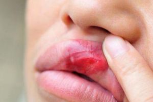 Cancerul cavitatii orale: simptomele de debut trec neobservate