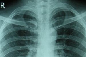 Acestea sunt cele cinci obiceiuri zilnice care îţi distrug oasele. Tu faci asta?