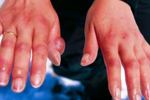 Cum procedăm în caz de degerături