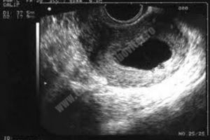 O GRAVIDĂ INFORMATĂ: Sarcina fără embrion