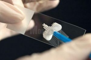 35 de sucevence au murit anul trecut de cancer de col uterin, deşi boala poate fi depistată ...