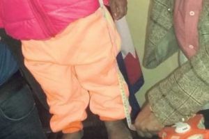 CAZUL care a CUREMURAT lumea medicală! La 19 ani are înălţimea şi greutatea unui BEBELUȘ - FOTO