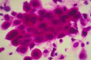 Nouă metodă de tratare a cancerului: vaccinul care dizolvă tumorile!